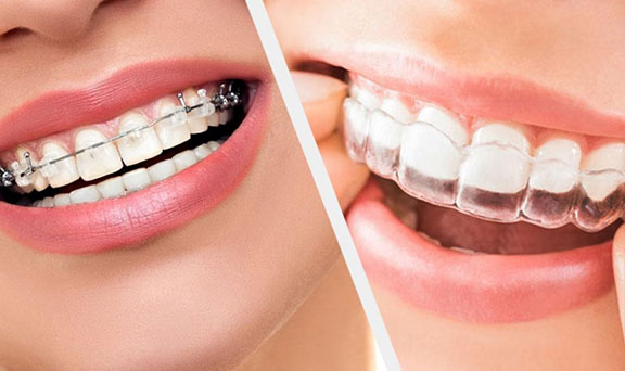 orthodontist_in_kharadi