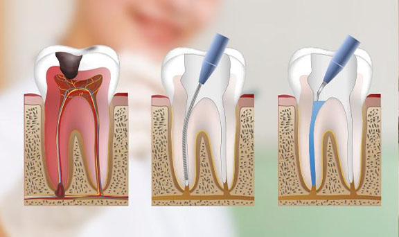 root-canal-in-kharadi