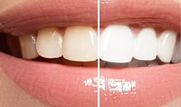 teeth-whitening-in-kharadi