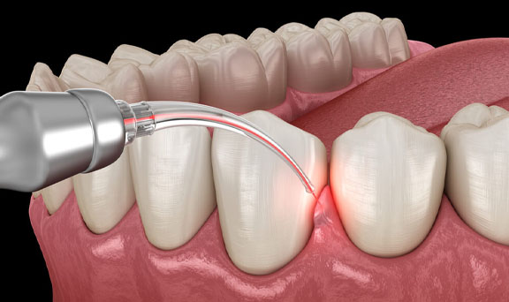 gum-surgery-kharadi